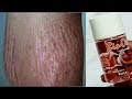 USE ONLY ONE OIL GET RID OF STRETCH MARKS FAST USE ONLY ONE OIL GET RID OF STRETCH MARKS FAST