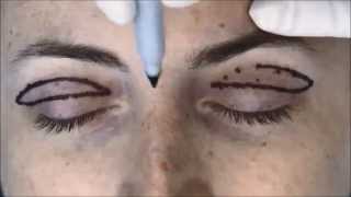 Markings for Upper Blepharoplasty