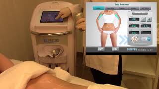 Body skin care protocol with the MPR toroidal RF treatment