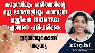 ശരീരത്തിൽ ഉണ്ണികൾ (Skin Tags) ഉണ്ടാകാനുള്ള കാരണങ്ങളും | പരിഹാരമാർഗങ്ങളും | How to remove Skin tags