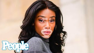 Winnie Harlow on Vitiligo Being Underrepresented in Media: \