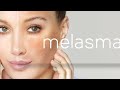 Melasma,Hyperpigmentation | झांँई! Electro Homeopathic medicine for melasma melasma explain