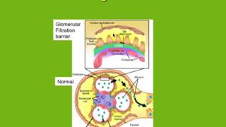 DAROGA Pre-eclampsia Part One