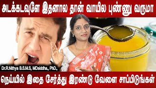 இந்தப் பிரச்சினை இருப்பவர்களுக்கு வாயில் புண் வரும் | Mouth ulcer causes , treatment | Dr.Nithya