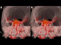 Cavernous Meningioma - 3D Virtual Tour | UCLA Neurosurgery