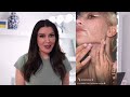 kim k s face lift scars hers vs mine…