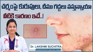 చర్మంపై చీము గడ్డలు || How to Prevent Cyst on Skin in Telugu || Sebaceous Cyst || Sankhya Hospitals