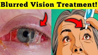 Blurred Vision: Causes, Warning Signs \u0026 Natural Treatments You Need to Know!