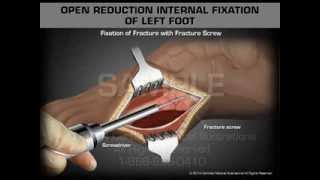 Open Reduction Internal Fixation of Left Foot