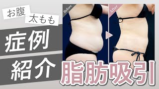 この変化はダイエットじゃ手に入らない！お腹・太ももの脂肪吸引の症例を医師が徹底解説#湘南美容クリニック  #脂肪吸引 #整形  #スタイル  #ダイエット