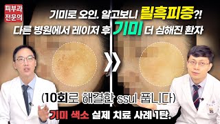 기미∙릴흑피증 치료 사례 | 색소침착 치료 제대로 받으려면 꼭 알아둘 Tip 대방출!✨