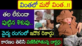 వైద్య రంగంలో మరో రికార్డు! తల లేకుండా పుట్టిన బిడ్డ చూసి నివ్వెరపోతున్న డాక్టర్లు viral News