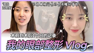 【韩国整形】 我的双眼皮修复术前术后1个月的记录Vlog | 整形记录篇 术后变化