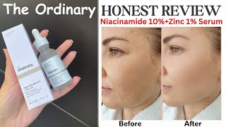 The Ordinary Niacinamide Serum Review: Benefits, Results \u0026 My Honest Experience