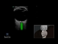 how to ocular ultrasound 3d video