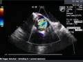 Quadleaflet Aortic Valve