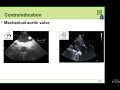 routine use of tee to guide mechanical circulatory support for cardiogenic shock priya menon de