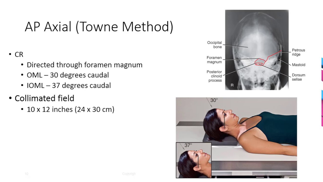 Radiographic Positioning Of The Skull - YouTube