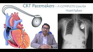 CRT P / CRT D Pacemaker - Complete Cure for Heart Failure