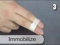 how to treat a jammed finger or toe