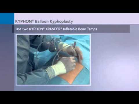 Explanation Of Balloon Kyphoplasty Part 1