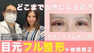 【ダウンタイム公開】目元整形（たるみ取り併用全切開二重術＋目尻切開＋下眼瞼下制＋クマ取り＋CRF）全部してみたけど、どこまで自然になるの？