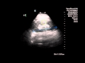 Normal Renal Arterial Doppler - Case Study