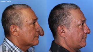 Plastic surgeon offers painter life-changing surgery on nose deformity