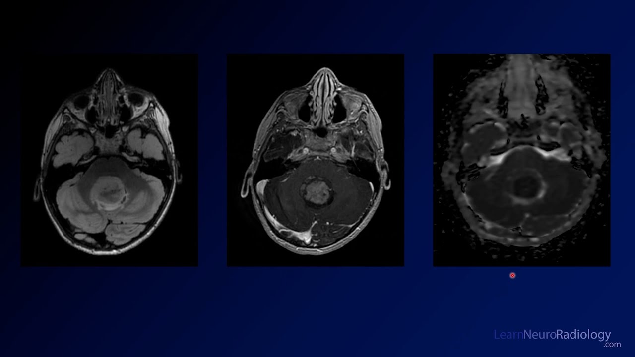 Neuroradiology Board Review - Brain Tumors - Case 10 - YouTube