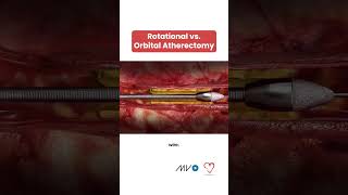 Rotational vs. Orbital Atherectomy