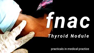 Fine-needle Aspiration Cytology in the Diagnosis of Thyroid Nodule।।