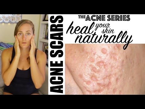 Healing Acne Scars NATURALLY! 🌺 Healing Acne Scars NATURALLY! 🌺