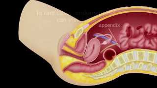 Video 3.1 Endometriosis