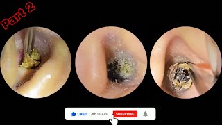 Earwax Removal ASMR – Most Relaxing Compilation (Part 2)