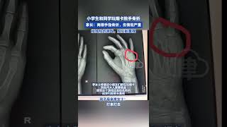 小学生和同学玩烟卡致手骨折！家长：两根手指骨折， 挺危险的游戏，应引起重视 #烟卡