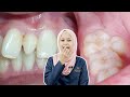 Tengok Video Ini Jika Anda Ada Gigi Lebih