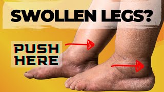 Natural Remedies for Leg Swelling: Discover the Power of 4 Acupressure Points