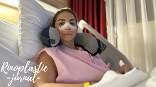 Rinoseptoplastie | Experienta mea, before and after si recuperare