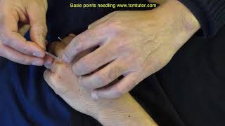 How to needle Baxie (Eight Pathogens) points