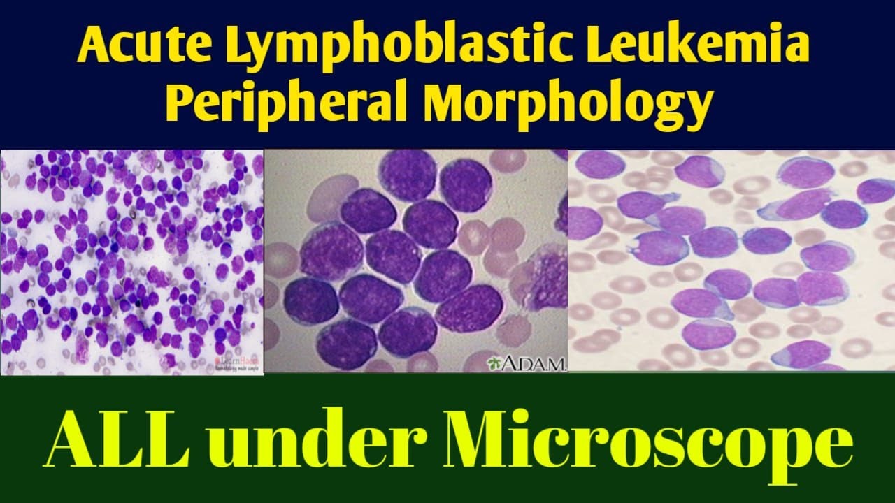 Acute Lymphoblastic Leukemia Peripheral Morphology | ALL Under ...