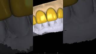 veneers design #cadcam #exocad #dentalworld #dentaltechnician #dentist