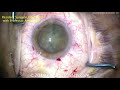 chopping the nucleus without using the phaco probe in cataract surgery