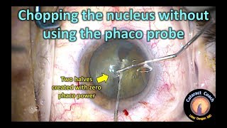 Chopping the nucleus without using the phaco probe in Cataract Surgery