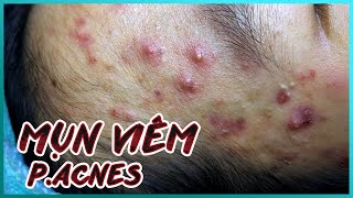 Big Cystic Acne Blackheads Extraction Blackheads \u0026 Milia, Whiteheads Removal Pimple Popping