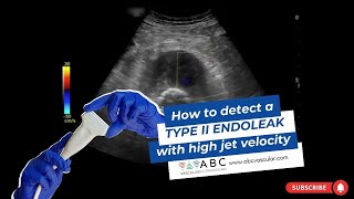 How to detect an endoleak: type II endoleak with high jet velocity. Ultrasound of EVAR