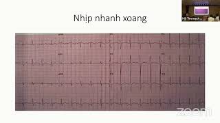 Cơn tim nhanh trên thất, tim nhanh QRS hẹp