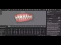 Carriere Motion Appliance - Invisalign