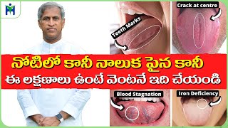 What Your Tongue Says About Your Health | Mouth Ulcer | Dr Manthena Satyanarayana Raju Videos