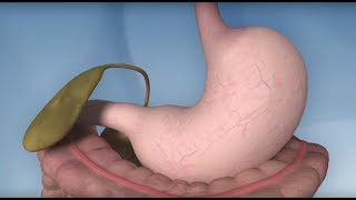 Gastric Bypass Complications - Mayo Clinic