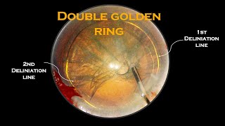 Clip #43 - Double Golden Ring: Aspirating a Cataract with ¨0¨ phaco power